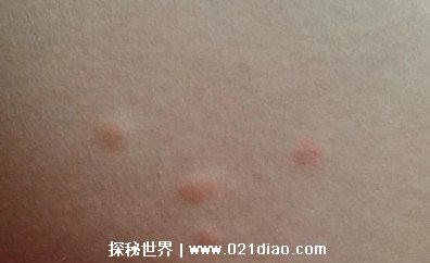 螨虫叮咬后的症状图，5个螨虫叮咬后的表现