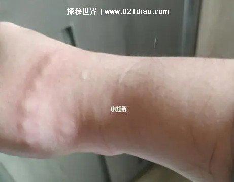 螨虫叮咬后的症状图，5个螨虫叮咬后的表现