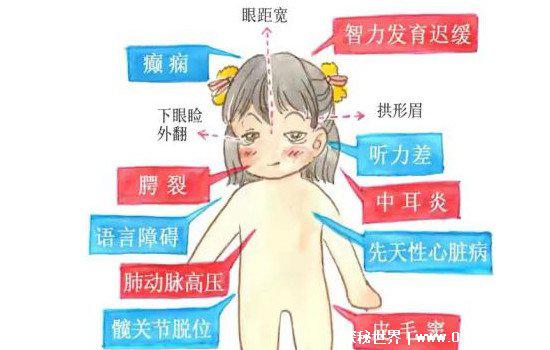 歌舞伎综合症真的漂亮吗，并不全是(有的不但腭裂还小头畸形)