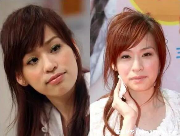 王心凌整容真相，实际是患有脸部蜂窝织炎而导致面部变形