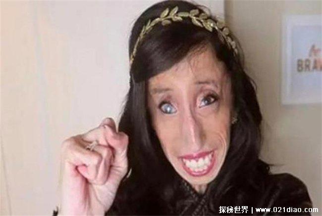 世界上最瘦的人，丽兹·维拉斯奎兹兹(27.3公斤)