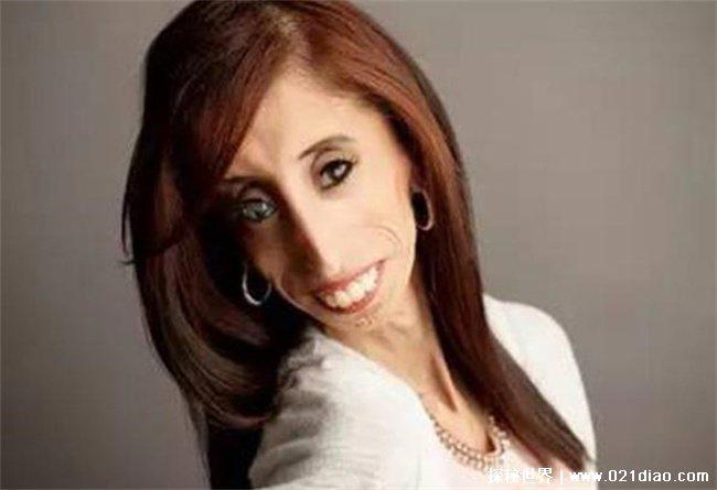 世界上最瘦的人，丽兹·维拉斯奎兹兹(27.3公斤)