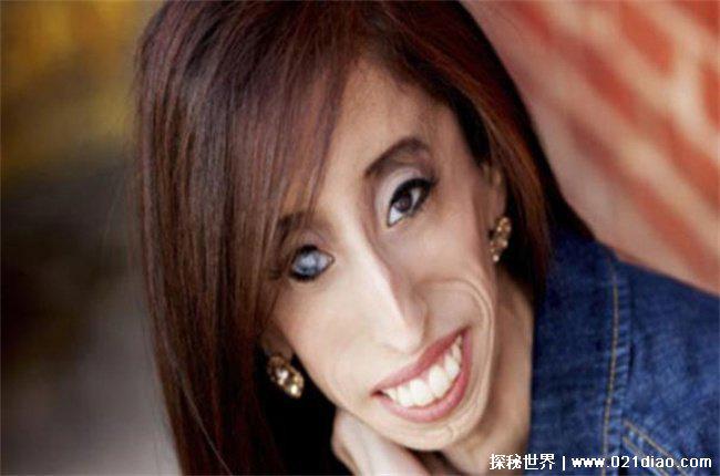 世界上最瘦的人，丽兹·维拉斯奎兹兹(27.3公斤)