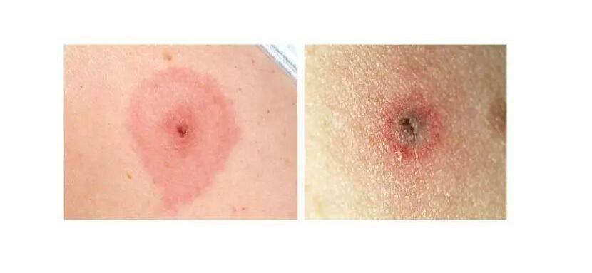 蜱虫咬人后的伤口图,教您如何应对蜱虫咬伤快速消灭蜱虫