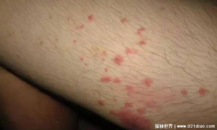 蜱虫咬人后的伤口图,教您如何应对蜱虫咬伤快速消灭蜱虫