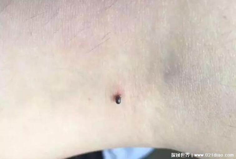 蜱虫咬人后的伤口图,教您如何应对蜱虫咬伤快速消灭蜱虫