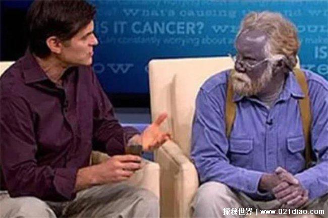 蓝种人是否真实存在，真实存在(全身是蓝色)