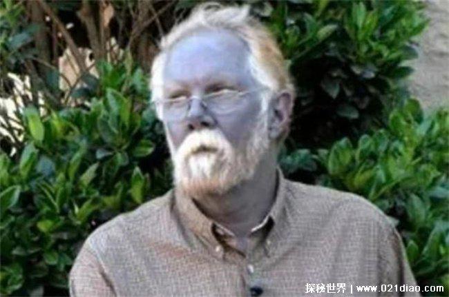 蓝种人是否真实存在，真实存在(全身是蓝色)