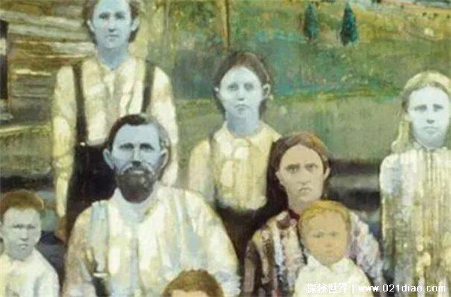 蓝种人是否真实存在，真实存在(全身是蓝色)