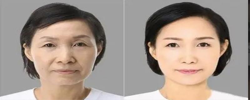 伊维兰除皱多少钱