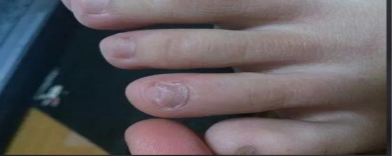 脚趾甲变厚是什么原因所导致的