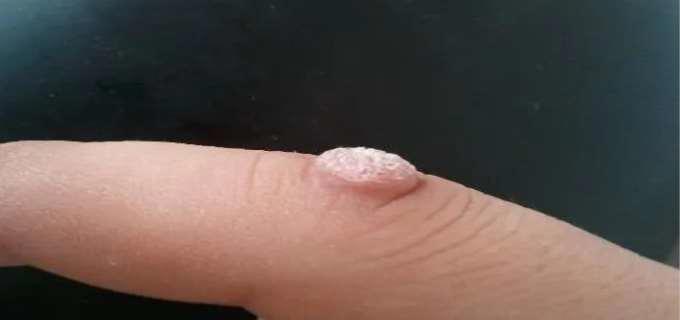 手上长瘊子怎么去除