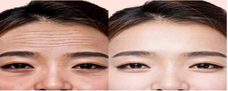 如何祛除额头纹