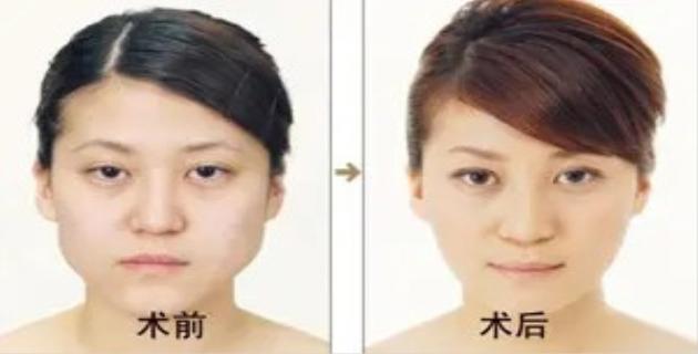 做割眼袋一般需要多少钱