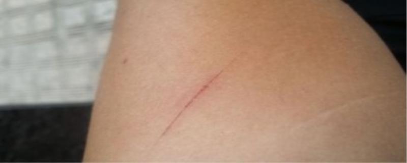 被猫抓了怎么判断没事