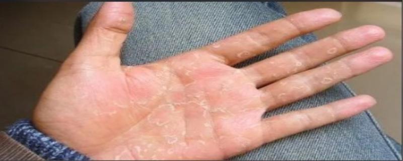 手脚脱皮是什么原因