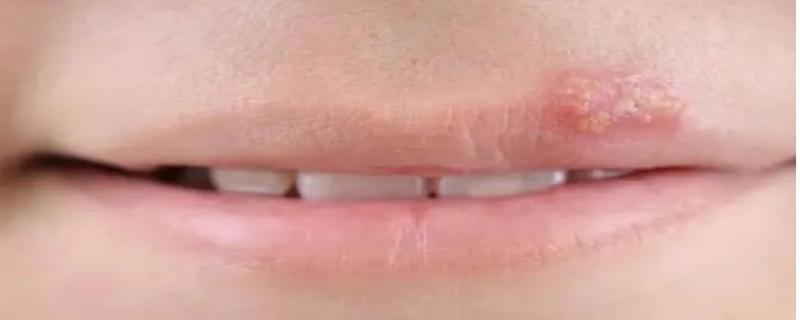 一夜之间嘴唇上起泡是什么原因