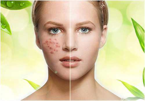 深圳祛痘哪家强 盘点前五名美容机构