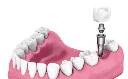 良心医生不建议种植牙