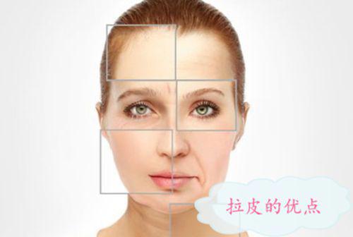 手术拉皮去皱效果好吗 做一次拉皮能维持多久