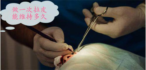 手术拉皮去皱效果好吗 做一次拉皮能维持多久