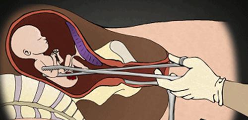 从佛角度告诉你堕胎的果报有多严重