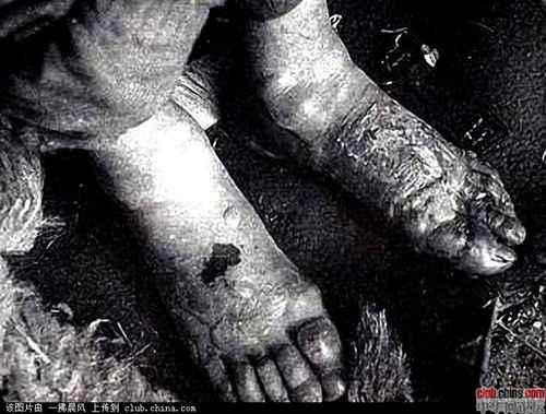 揭秘731部队冻伤实验