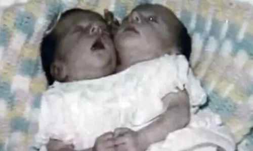 图说全球最奇特连体人