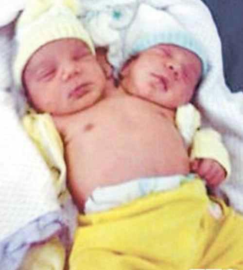 图说全球最奇特连体人