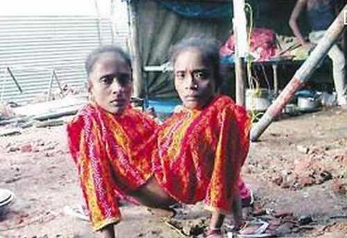 图说全球最奇特连体人