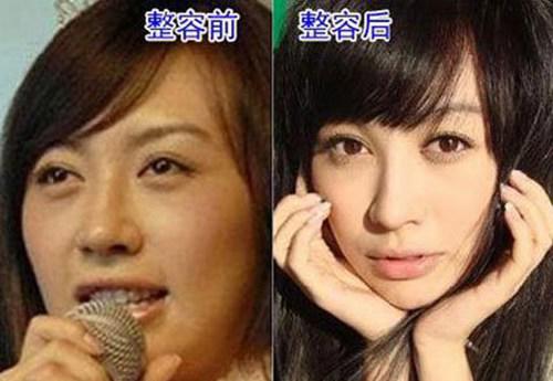 李菲儿整容是真的吗？
