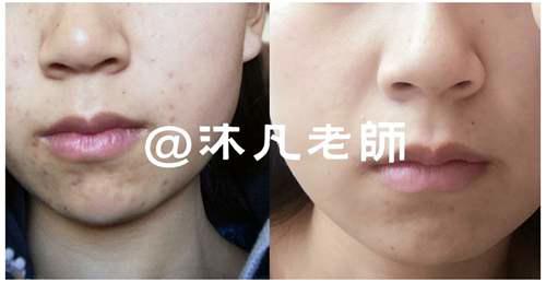 如何正确祛痘护肤步骤 这些技巧你一定要了解