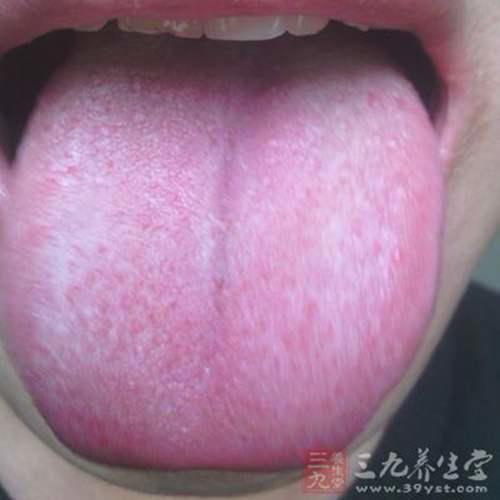 舌苔厚黄是怎么回事 舌苔厚黄是什么原因