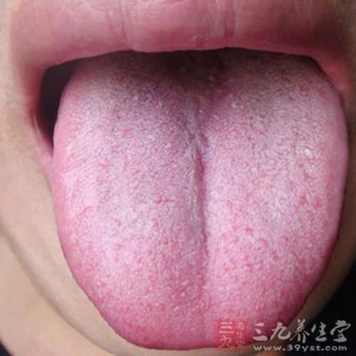 舌苔厚黄是怎么回事 舌苔厚黄是什么原因