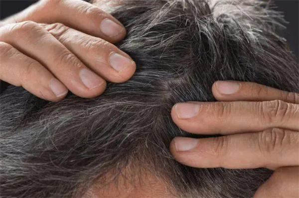 白头发长得多且快怎么办(有些生活细节要注意)