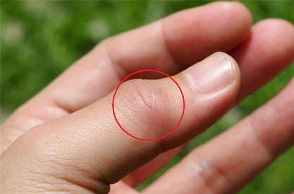 痛风的年轻人为什么越来越多？再不看就晚了