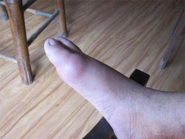 痛风的年轻人为什么越来越多？再不看就晚了