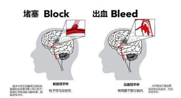 喝什么可以预防脑梗、脑溢血、疏通血管？家里有病人的必看