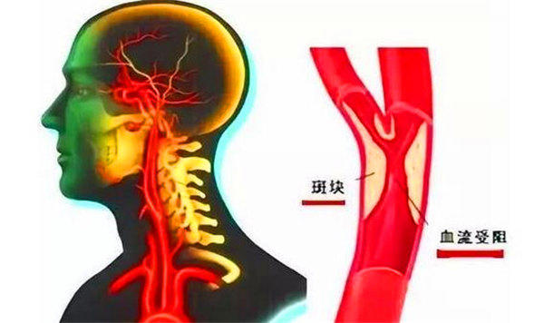喝什么可以预防脑梗、脑溢血、疏通血管？家里有病人的必看