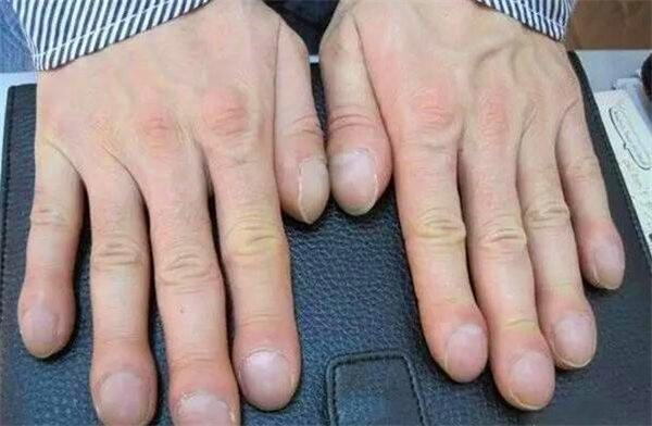 从手和脚怎么看出来肾不好？看完你也是半个医生