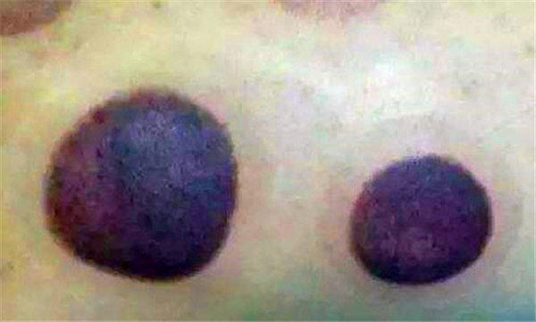 拔罐后身上的黑色印记是身体里的毒素吗？太吓人了