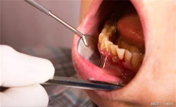 牙缝里的牙结石怎么去除(牢记这三个方法)