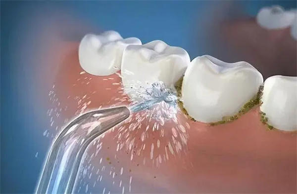 牙缝里的牙结石怎么去除(牢记这三个方法)