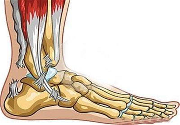 易建联受伤跟腱断裂有多严重？带你了解一下跟腱断裂