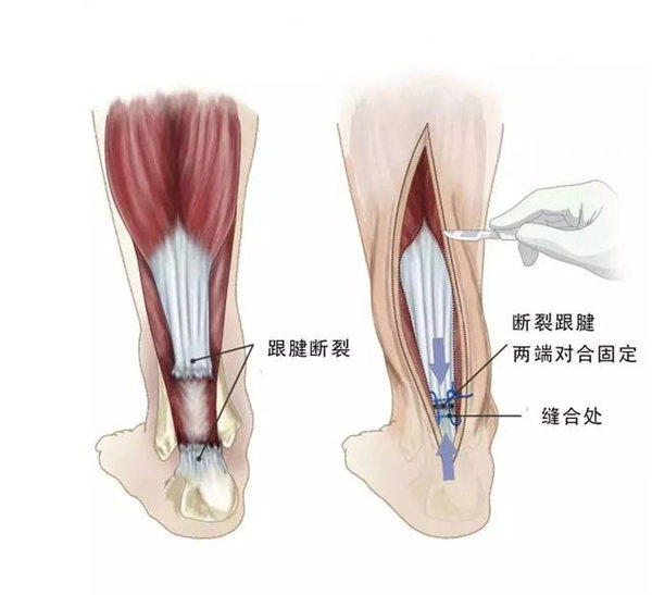 易建联受伤跟腱断裂有多严重?带你了解一下跟腱断裂