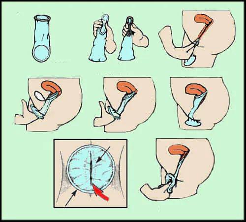 女用避孕套你会用吗?图解实演女用避孕套